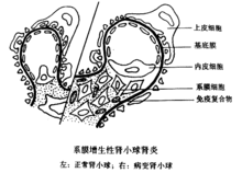 系膜毛细血管性肾小球肾炎 系膜毛细血管性肾小球肾炎